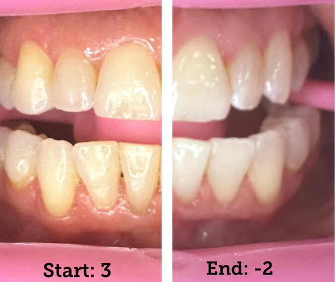 before and after of client's teeth