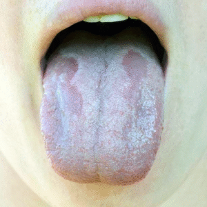 Thrush: Why You Should Never Come to a Whitening Appointment With a Mouth Infection