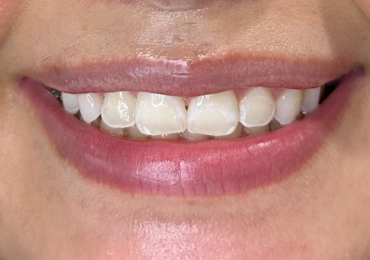 Bestie Teeth Whitening